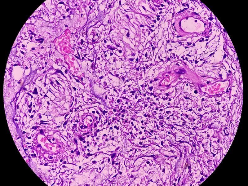 Hope for New Prognostic Biomarkers & Therapeutic Options From Tumour Metabolism-Targeting Breast Cancer Study
