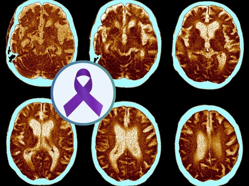Feinstein Institutes Links Blood Biomarkers to Psychosis in Alzheimer’s Patients