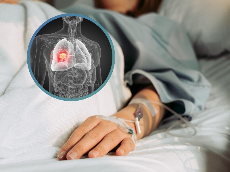 Group Identify Prognostic Biomarker for SCLC and Treatment Using Chemotherapy