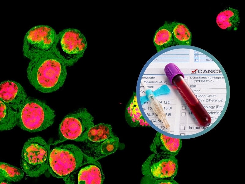 Proteomic Analysis of Serum Extracellular Vesicles Reveals Potential Biomarkers for Neuroblastoma